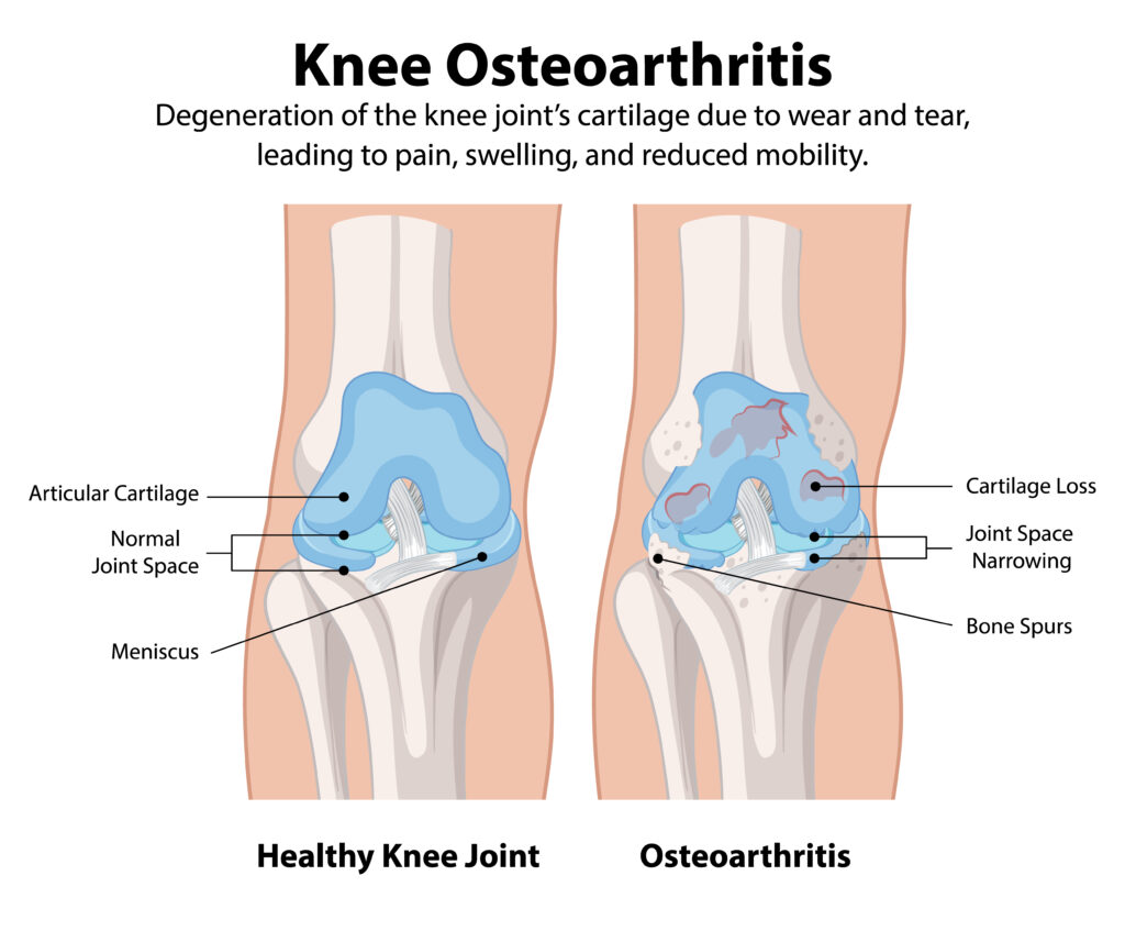 Joint Pain After 50
Healthy knee joint vs osteoarthritis knee joint
