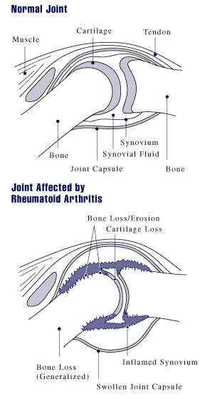 osteoarthritis (OA) and rheumatoid arthritis (RA)
