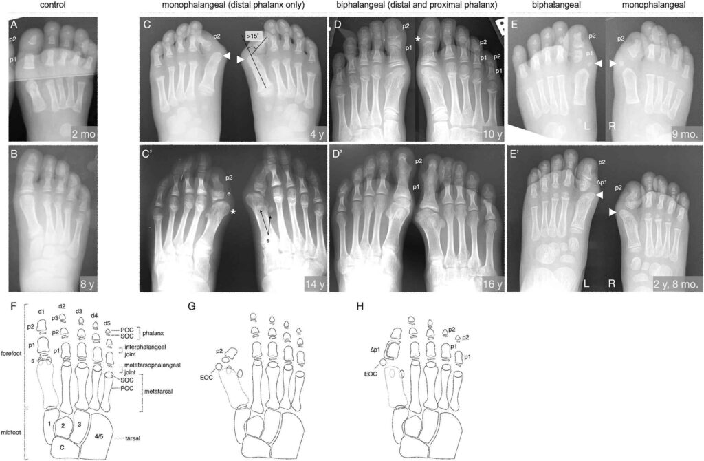 Radiographic and schematic comparison of great toe malformations in FOP