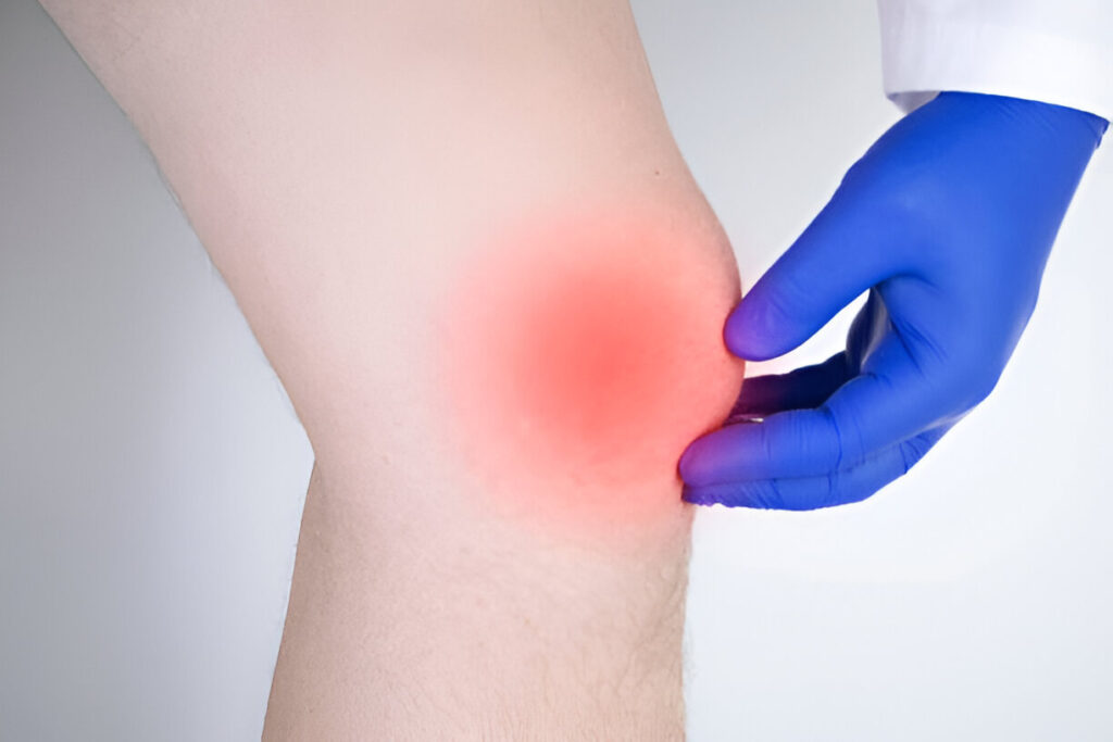 Lyme-disease-joint-pain-with-knee-swelling