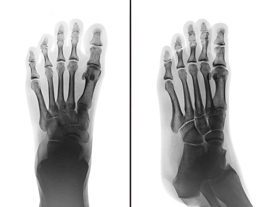 Normal structure of foot without
Fibrodysplasia Ossificans Progressiva