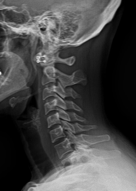 X-rays of a case of Atlantoaxial Subluxation