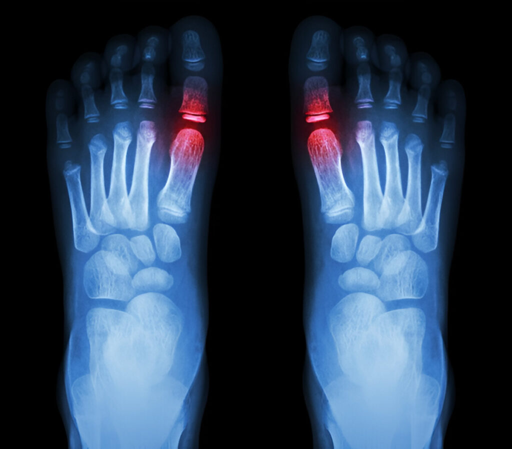 X-rays of foot showing Arthritis of the Big Toe