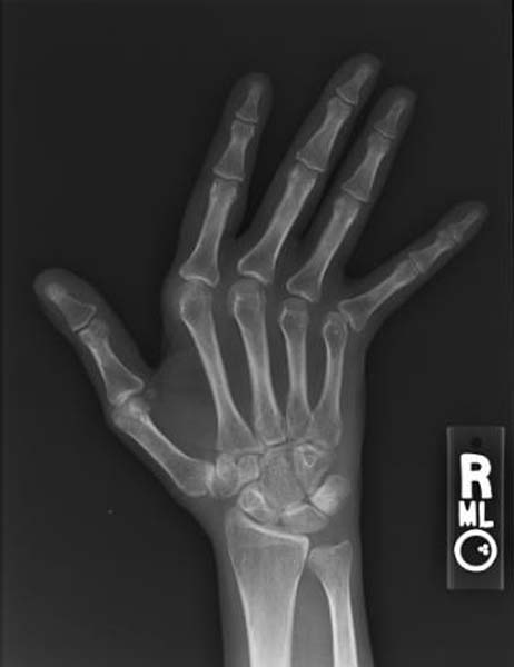 X-rays showing lateral deviation of fingers in jaccoud's arthropathy