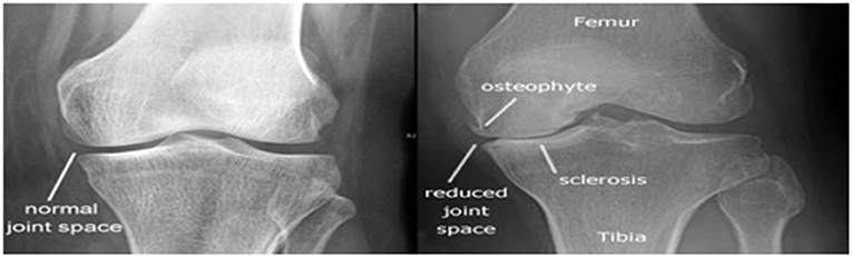 Tricompartmental Osteoarthritis of the Knee