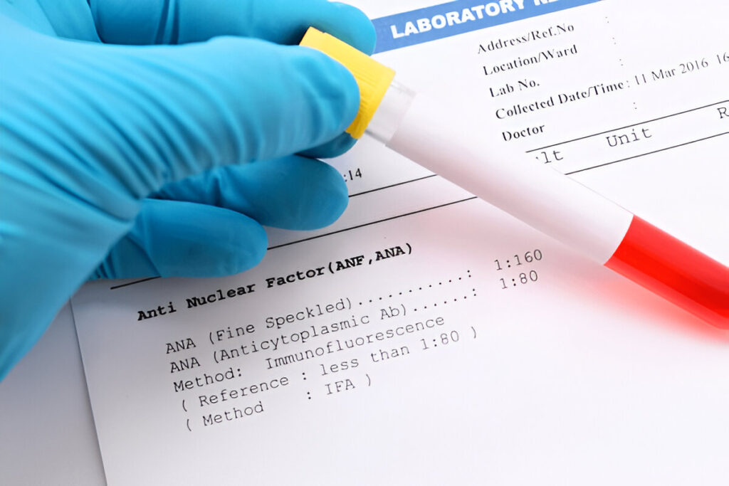 Anti nuclear factor (ANF) positive result, diagnosis for autoimmune disease, Lupus Arthritis