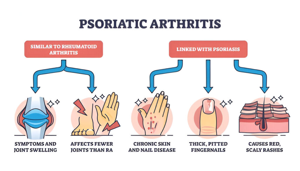 Psoriatic arthritis as chronic dermatological skin condition outline diagram. Labeled educational scheme with illness symptoms like joint swelling, pitted fingernails and rashes