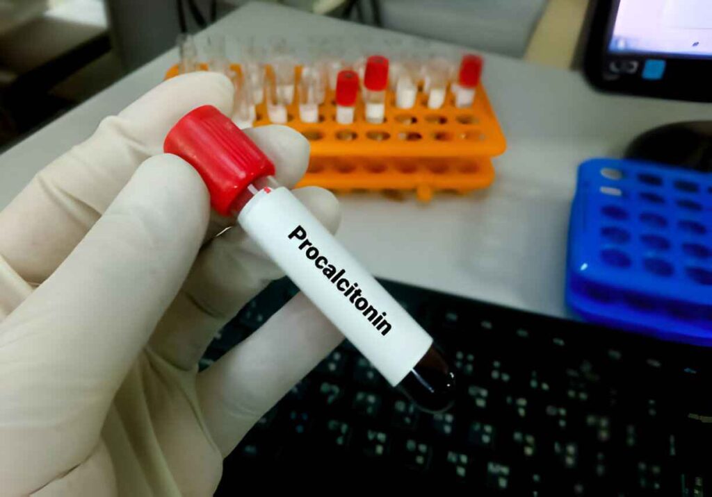 Procalcitonin test for diagnosis of Sacral Osteomyelitis