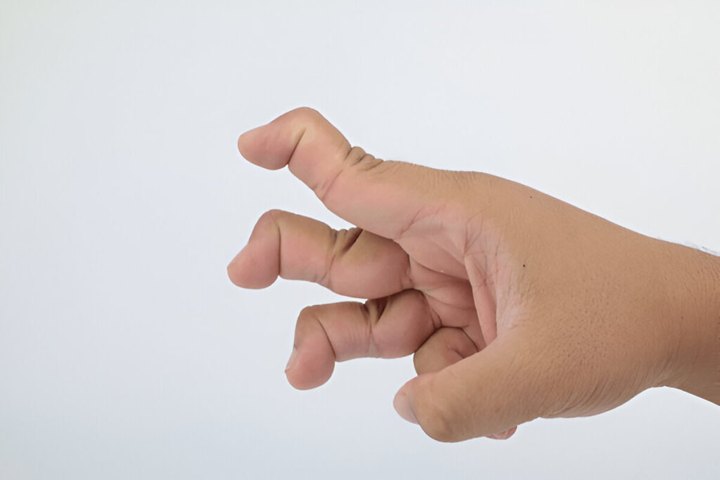 Swan neck deformity in jaccoud's arthropathy