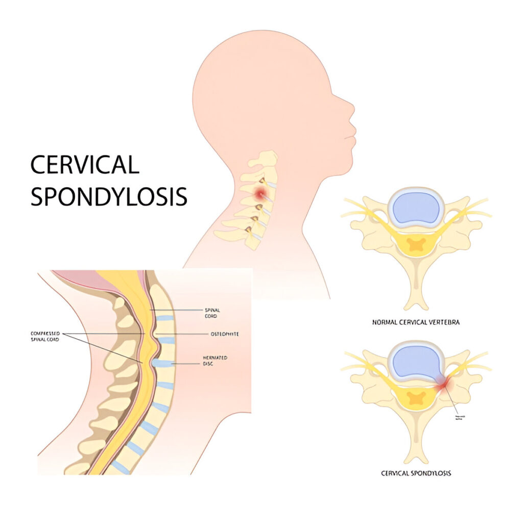Cervical spondylosis, a cause of Arthritis in the spine