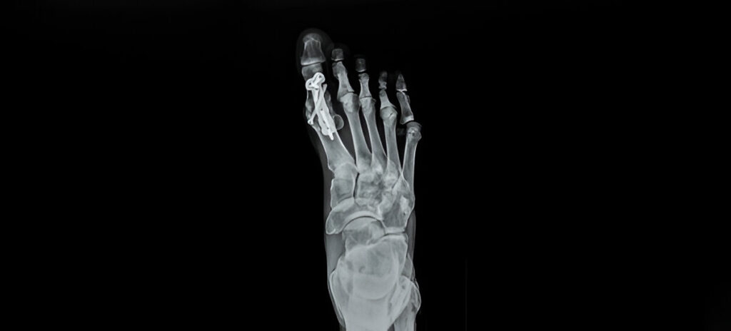 Photo of a foot in AP position on a dark background. The radiology shows hallux rigidus after metatarsophalangeal arthrodesis. Fusion is used to relieve pain.