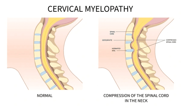 Cervical Myelopathy with painful pinched nerves