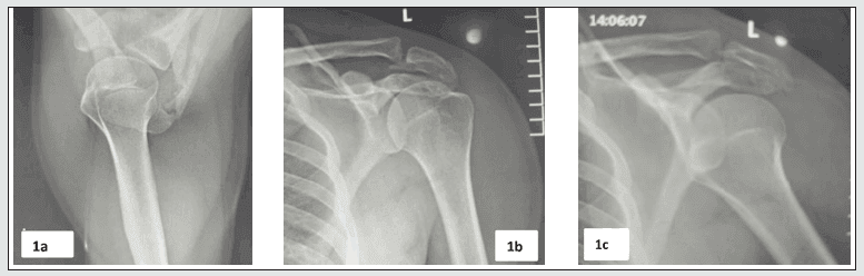 Outcome of Arthroscopic Bankart’s Repair Using Trans-Glenoid Suture Technique," Orthopedics and Sports Medicine Journal, Lupine Publishers
