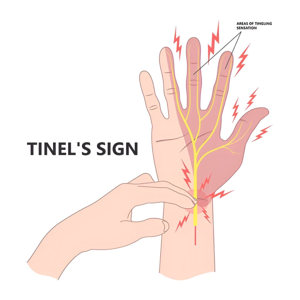 Tinel’s and phalen's sign test for carpal tunnel syndrome