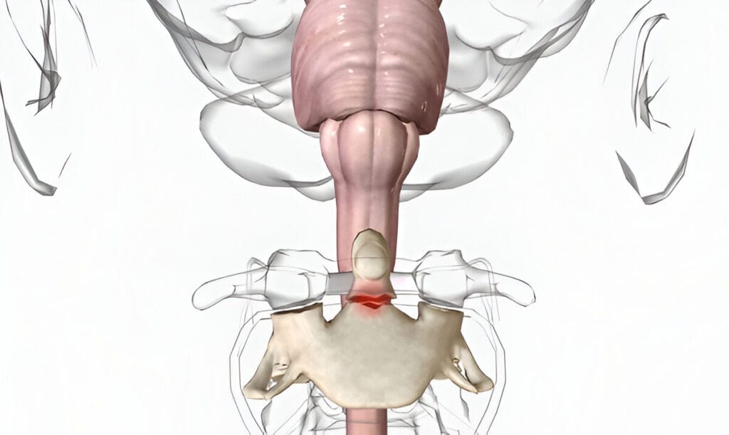 Odontoid (dens) fractures 3D rendering: os odontoideum and odontoid fractures
