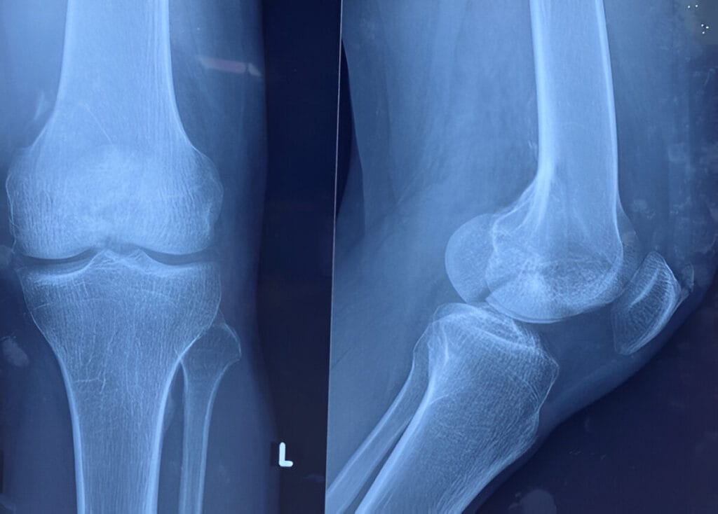 Fracture of distal femur
medial condylar fracture
Articular fracture