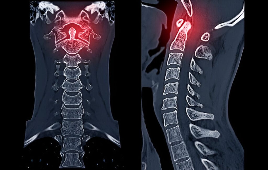 CT C-Spine or Cervical spine Coronal view in patient trauma cervical spine injury showing odontoid process or dens:
os odontoideum and odontoid fractures