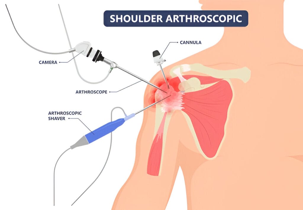 Shoulder Arthroscopy in Glenohumeral Degenerative Joint Disease