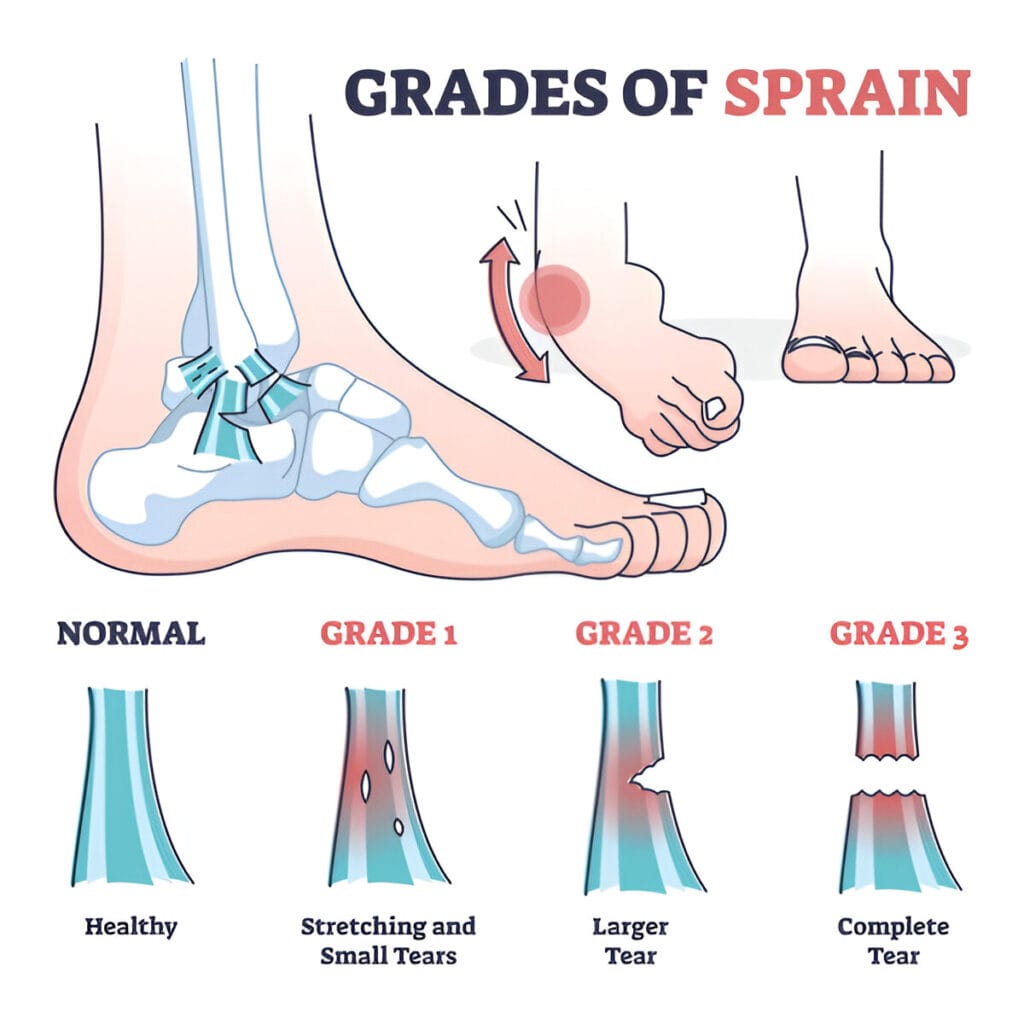 Grades of sprain as ankle or foot medical injury levels outline diagram. Anatomical leg problem significance measurement and division vector illustration. Healthy, stretching and tears explanation.