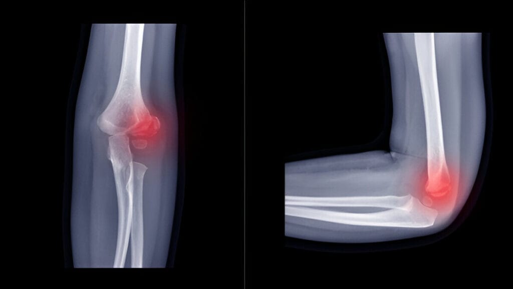 Film X-ray elbow radiograph show elbow bone broken (lateral condyle of distal humerus fracture) from fallen. Red highlight on fracture site and painful area.