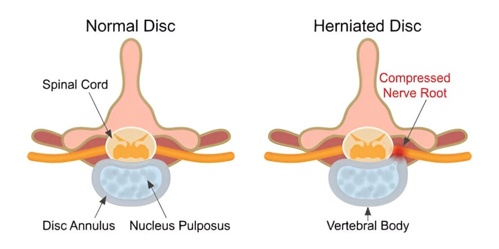 Herniated disc is a fragment of the disc nucleus that is pushed out of the annulus, into the spinal canal through a tear or rupture in the annulus.