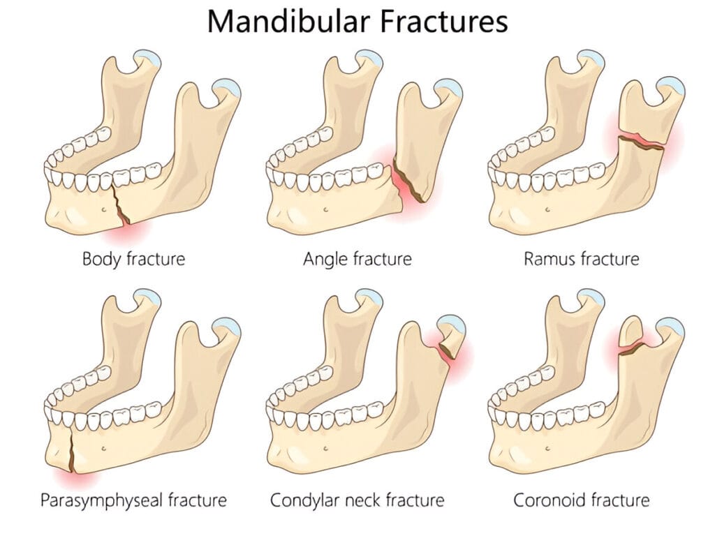 Mandibular fractures, also showing condylar fractures