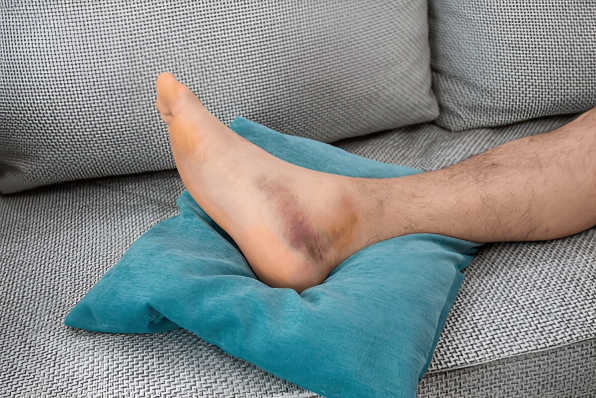 Broken Ankle with dislocation of young sports man.