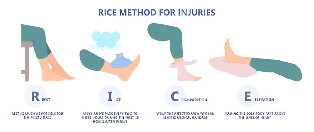 R.I.C.E. method for sprained ankle
