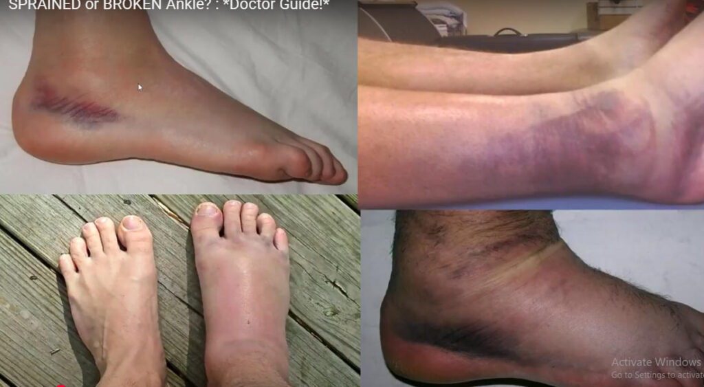 Sprained Ankle vs Broken Ankle